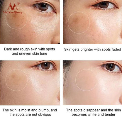 Moisturiser Face Whitening Freckle Cream Remove Acne Spots